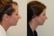 Rhinoplasty Surgery. 1 month post-op