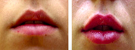 Female Lip Augmentation using Filler