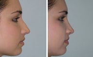 Subtle profile Rhinoplasty