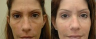 Lower Eyelid Surgery