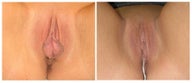 Labiaplasty