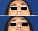Before and after septoplatsy