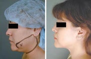 Chin Liposuction
