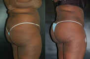 34 Year Old Female Treated for Body Contouring & BBL