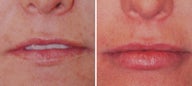 Beforenhancement with Juvederm Dermal Filler