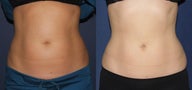 Before and After CoolSculpting