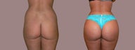 Brazilian Butt Lift to sculpt the waist, enlarge the butt