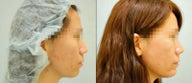 Chin Augmentation (Chin Implant)