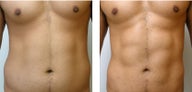 Vaser High Definition Liposuction