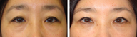Asian Female Blepharoplasty