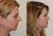 Revision Rhinoplasty Surgery. 8 months post-op.
