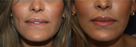 Lip augmentation female