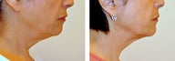 63 Year Old Female Treated with Ultherapy for sagging neck