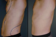 Smart Lipo