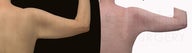 Body jet (water-assisted) liposuctioni of arms and brachioplasty after 100lb weight loss