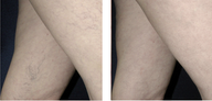 Spider Vein Treatment