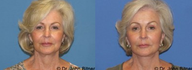 Brow Lift