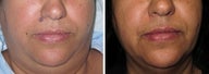 Mole Removal photos