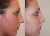 Rhinoplasty, profile view