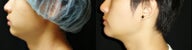 Chin Augmentation (Chin Implant)