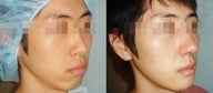 Chin Augmentation