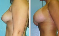 Breast Lift- Mastopexy