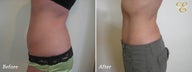 Smart Lipo