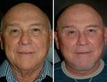 Facelift