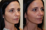 Rhinoplasty Surgery. 1 year post-op.