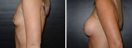 Breast Implants