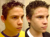 Ear Surgery