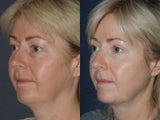 Before & After Ulthera in San Diego