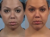 Chin implant for short lower third of face
