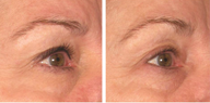 Ultherapy
