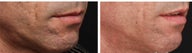Acne scar treatment