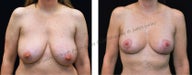 Breast Lift