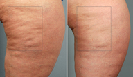 Cellulaze