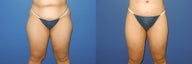 Before and after full body lift surgery