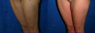 Thigh Lift after massive weight loss