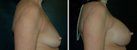Breast Implants