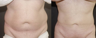 Liposculpture