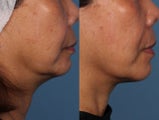 Ultherapy Treatment