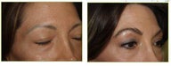 Eyebrow transplant