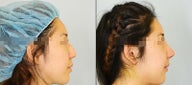Asian Rhinoplasty