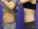 CoolSculpting