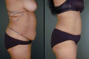 Pure Tumescent Liposuction