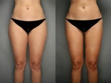 SmartLipo Liposuction of Thighs