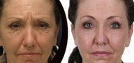 Face fat grafting with body jet (water-assisted liposuction)