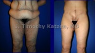 Leg Lift after weight loss surgery