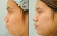 Asian Rhinoplasty